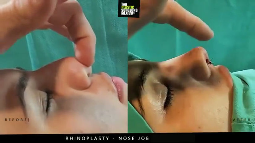 Nose Job - Rhinoplasty in Mexico - TopPlasticSurgeonsMexico 8